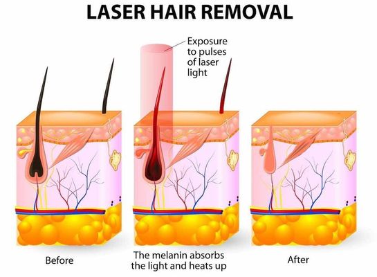 OPT IPL /는 다중기능의 기계 가지고 다닐 수 있는 IPL 빠른 모발 제거를 선택합니다